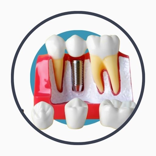 Benefits of Dental Implants