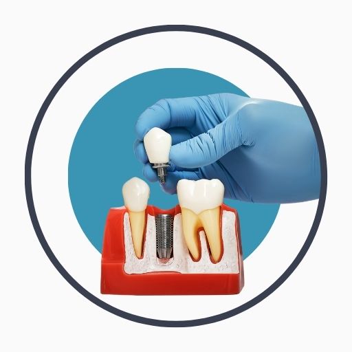 Overview of Dental Implants