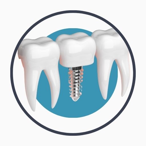 Steps of Dental Implant Surgery