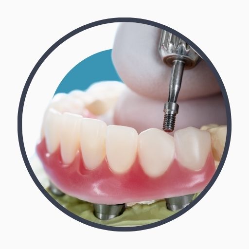 Risks of Dental Implants