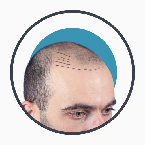 Preparing for a Hair Transplant Procedure