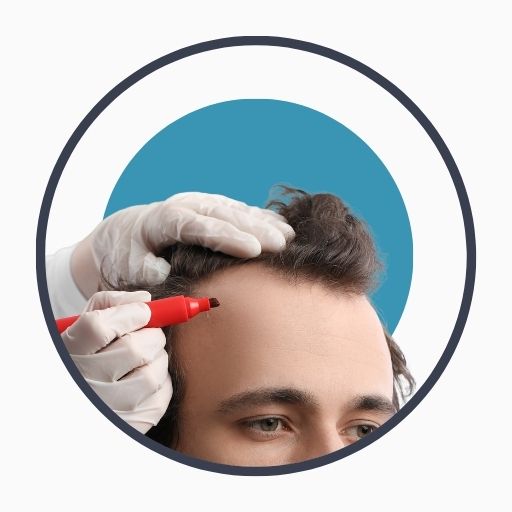 Benefits of Hair Transplant