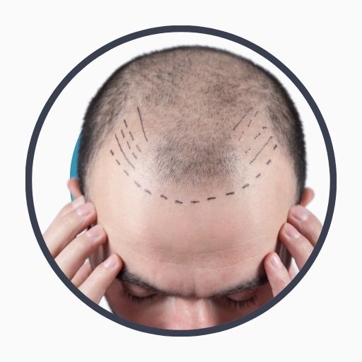 An Overview of Hair Transplant
