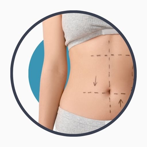 Steps of the Liposuction Procedure